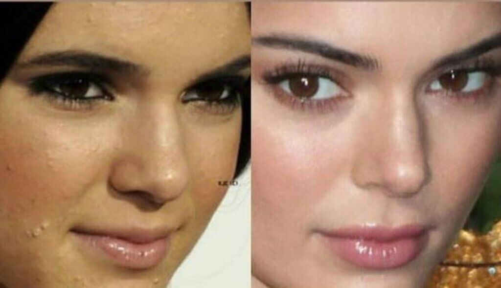 kendall jenner before and after plastic surgery